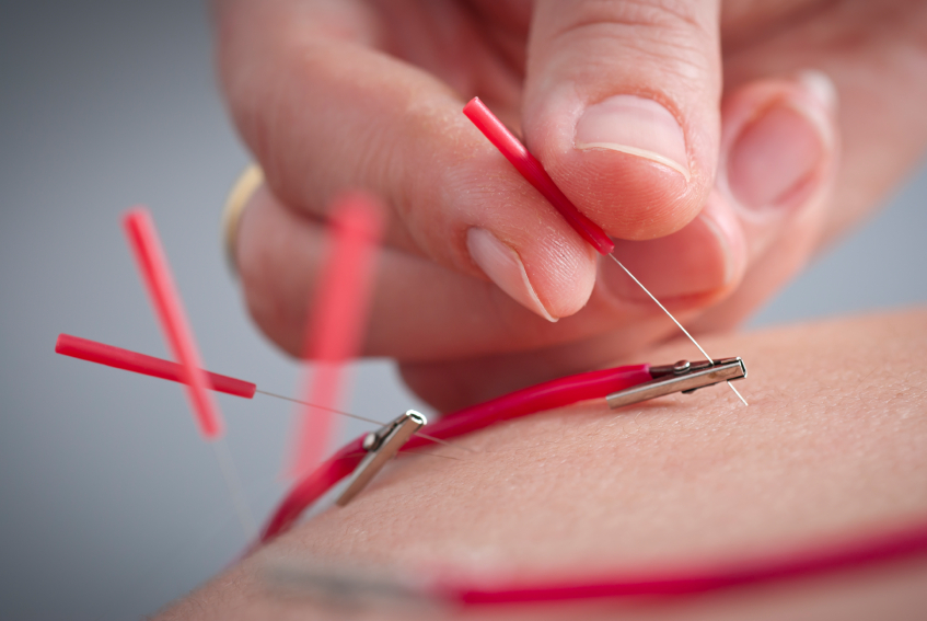 Electric_Acupuncture_847x567